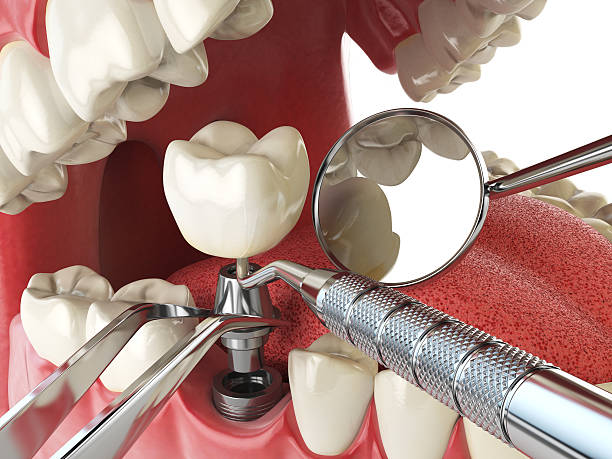 Best Emergency Tooth Extraction in Eastpoint, FL